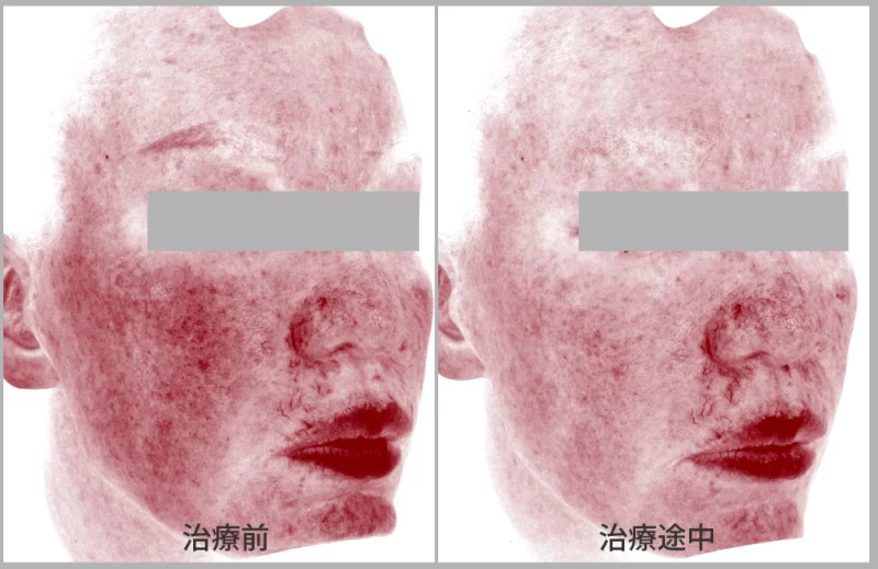 VISIAでの赤ら顔治療の経過