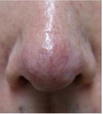 毛細血管拡張症分類の単純（線状）型