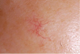 毛細血管拡張症分類のクモ状型