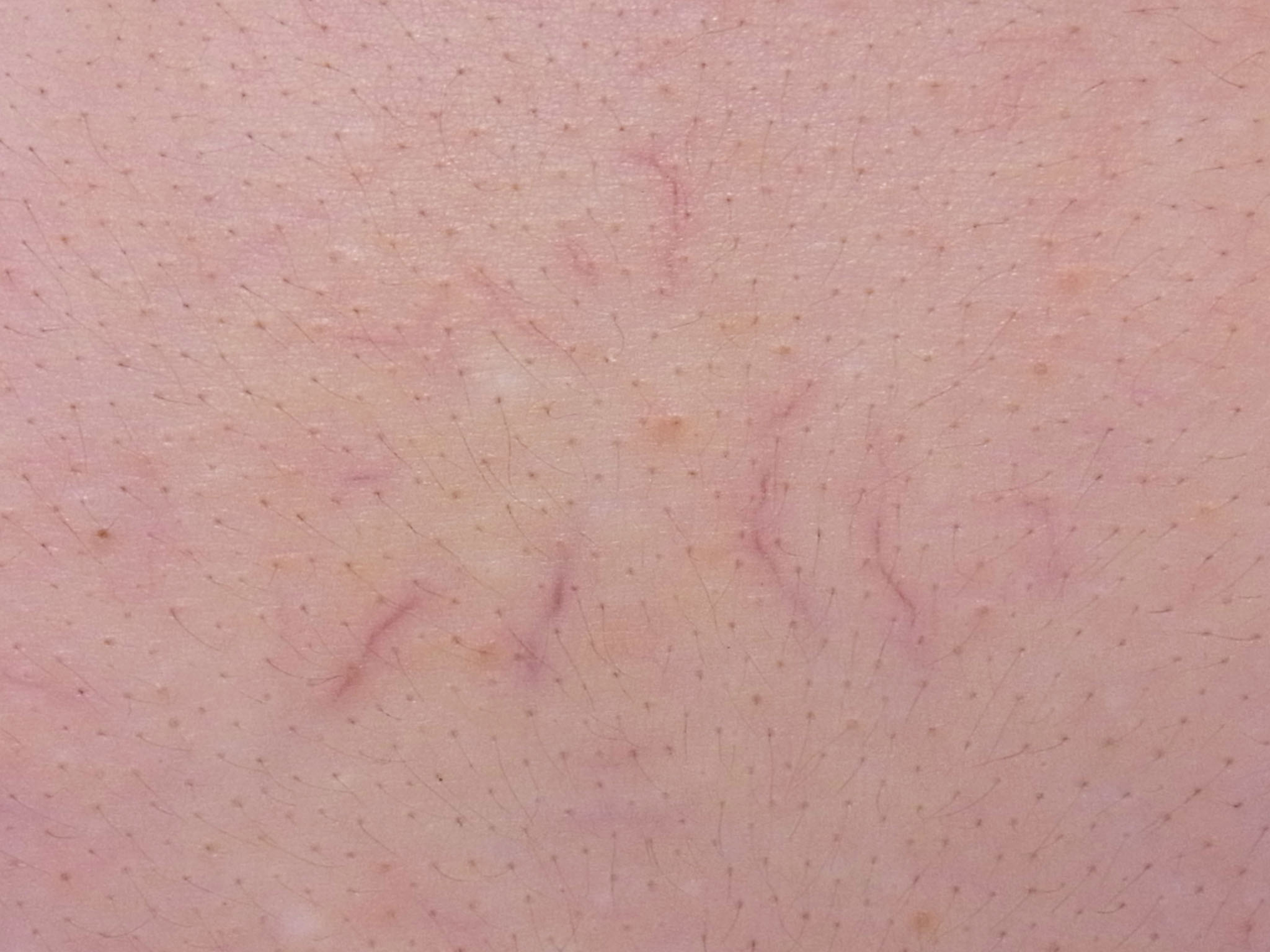 毛細血管拡張症分類の樹枝状型