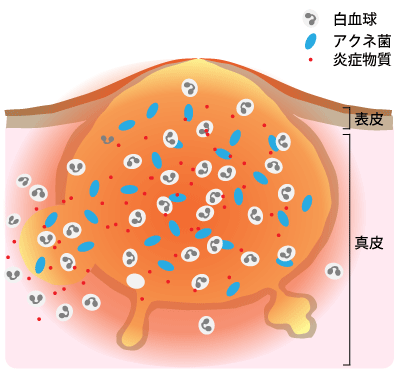 黄色いニキビの状態