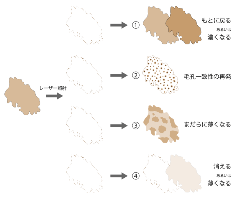 扁平母斑治療後の経過分類