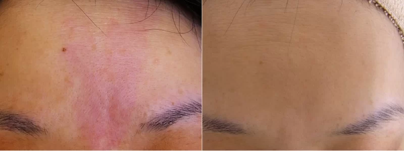 症例6. サーモンパッチ治療前後