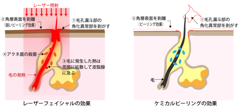 レーザーフェイシャルとケミカルピーリングの違い