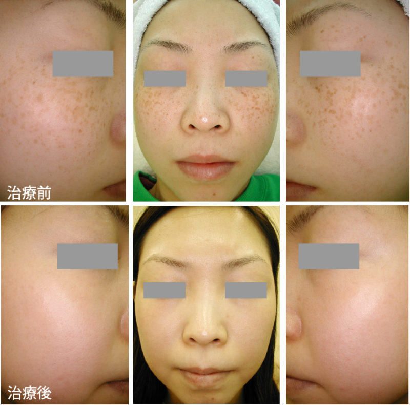 ソバカスのレーザー治療前後に写真