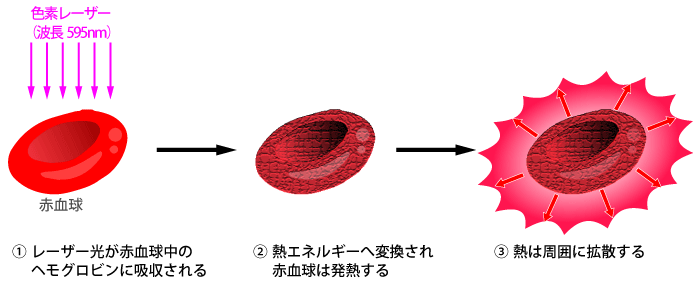 色素レーザーによる毛細血管拡張症の治療メカニズム