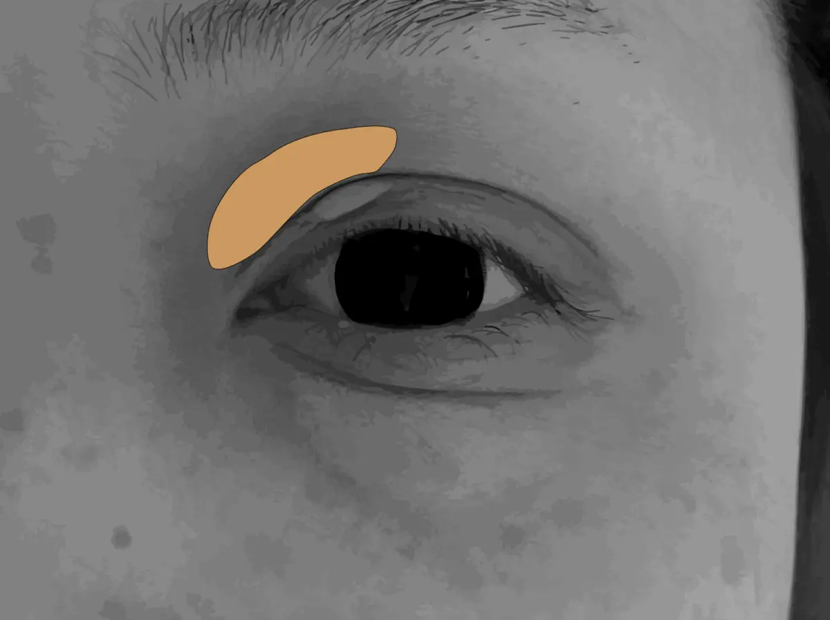 眼瞼黄色腫治療大きさイラスト（上眼瞼）