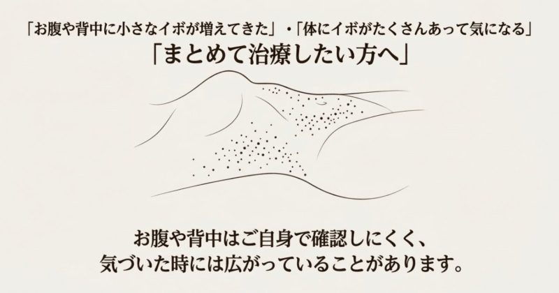 お腹や背中に小さなイボが広がっているイメージ図。体にイボがたくさんあり、まとめて治療したい方向けの案内画像
