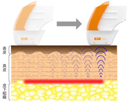 ウルトラフォーマーMPTのライナー式MPモード