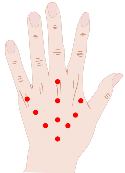 プロファイロの手背への注入ポイント