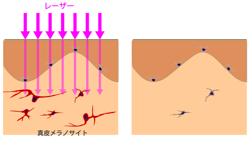 太田母斑　ADMでのレーザー治療のイメージ像