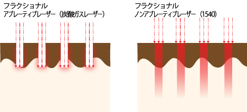 フラクショナルレーザーの種類と治療方法の違い