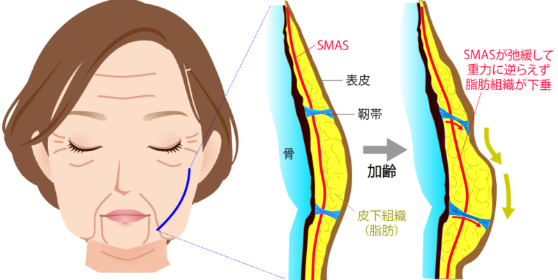 加齢により支持靭帯とSMASが緩む様子の図