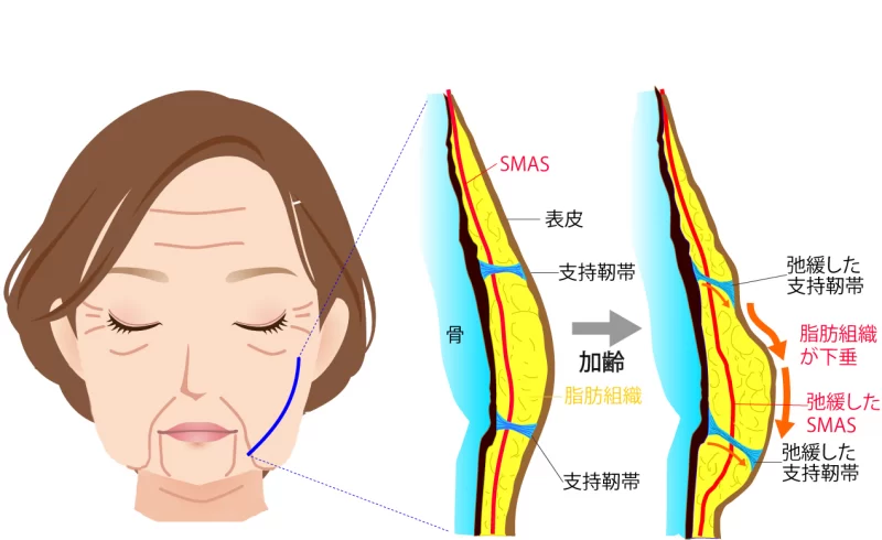 加齢による支持靭帯とSMASの変化