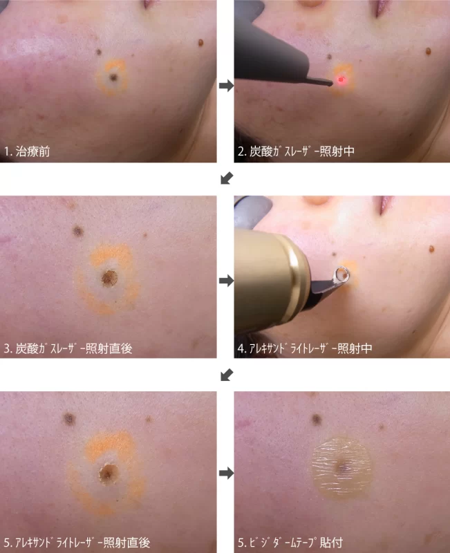スキャナ付き炭酸ガスレーザーとアレキサンドライトレーザーを用いたホクロ治療