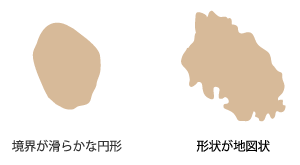 扁平母斑の形状でレーザーへの反応が異なる