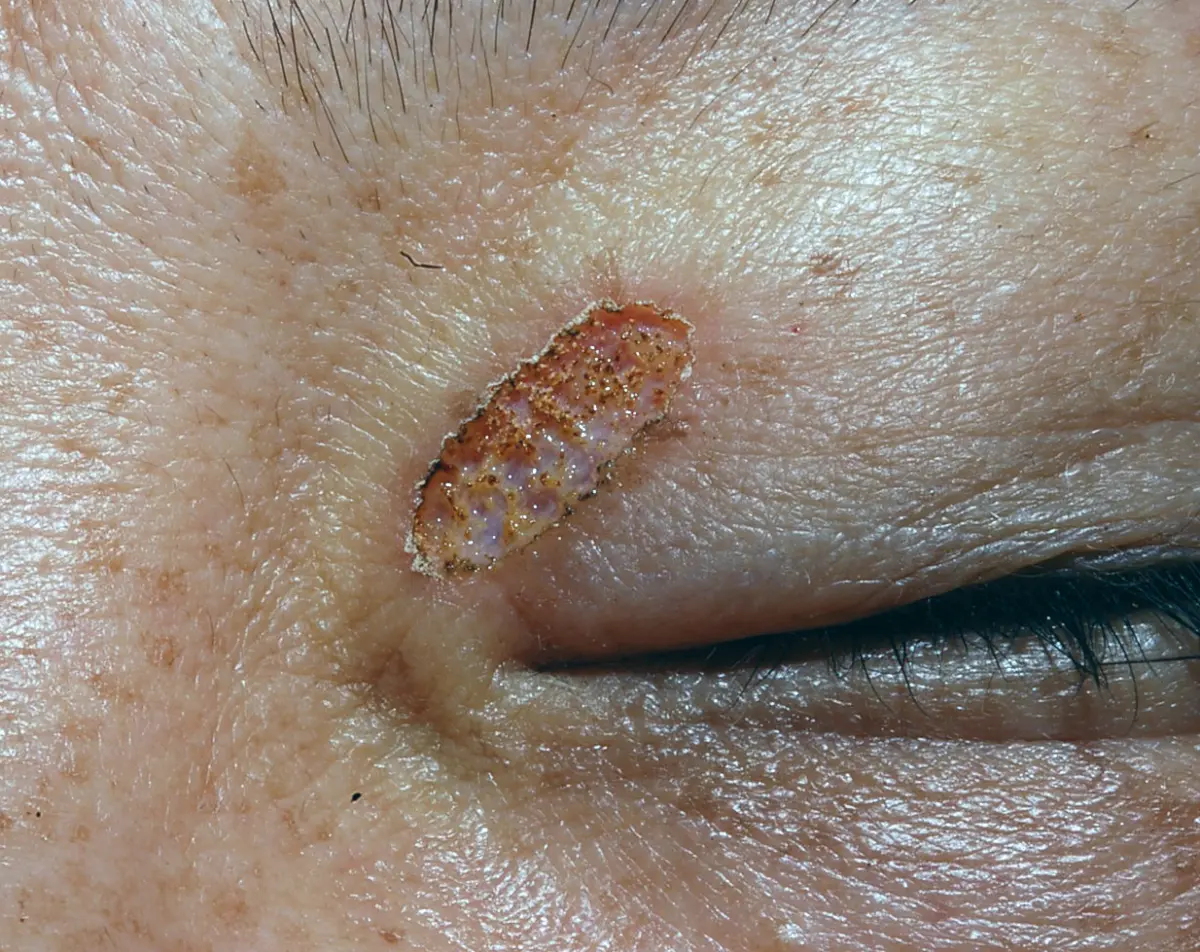 小さい眼瞼黄色腫