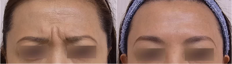 ボトックスによる治療写真（眉間額）