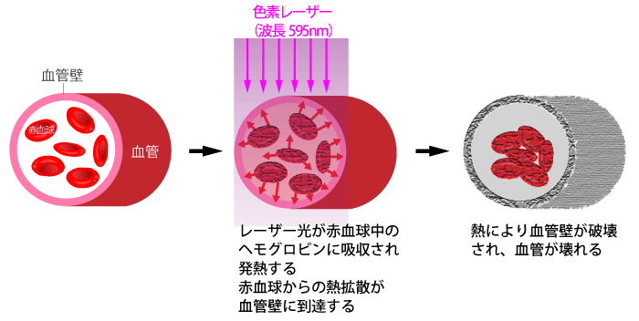 色素レーザーによる毛細血管拡張症の治療メカニズム2