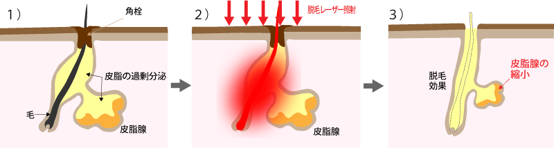 脱毛レーザーにより脂腺破壊のメカニズム