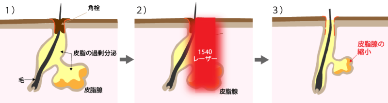 1540レーザーの毛穴治療のメカニズム