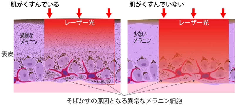 プレトリートメントの意義