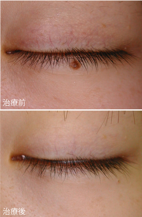 症例4の治療前後の写真