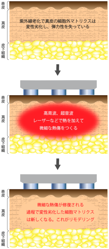 リモデリングのメカニズム