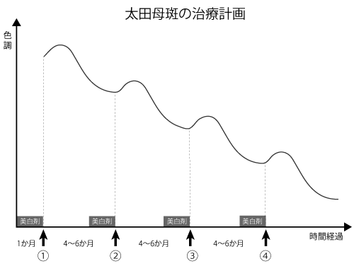 太田母斑のレーザー治療計画のイラスト