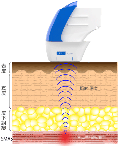 ウルトラフォーマーMPTでSAMSに熱傷をおこす