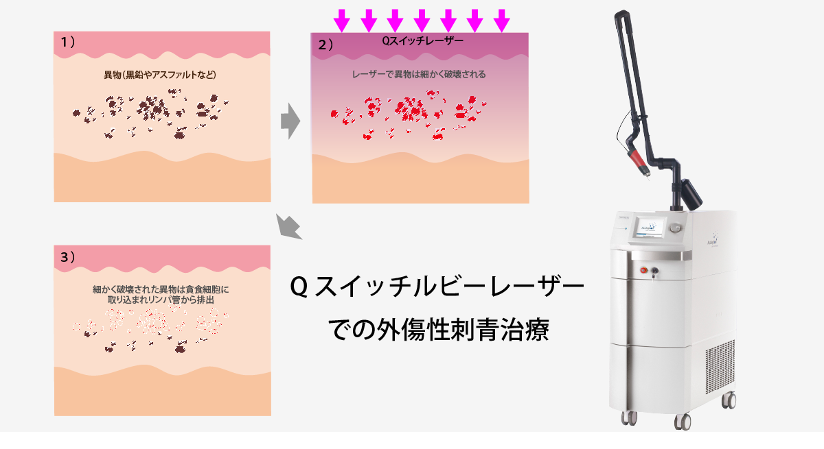 外傷性刺青（外傷性タトゥー）｜外傷性刺青に関して皮膚科専門医が解説