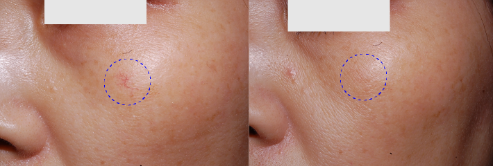 症例4. 小範囲の毛細血管拡張症の治療前後