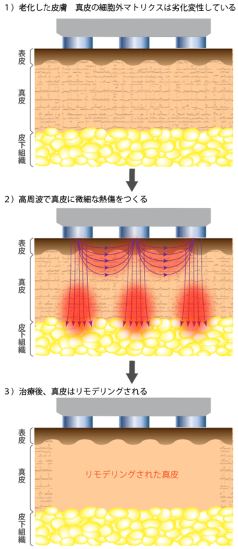 モノポーラーとバイポーラーの２つの照射方式