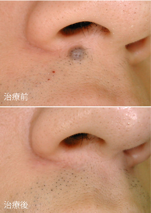 症例２の治療前後の写真
