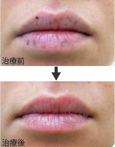 口唇ホクロ写真