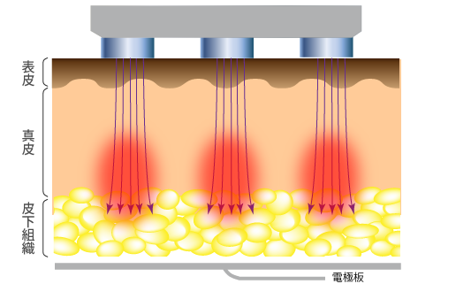 モノポーラーは高周波（RF）が皮膚の中を流れるイメージ