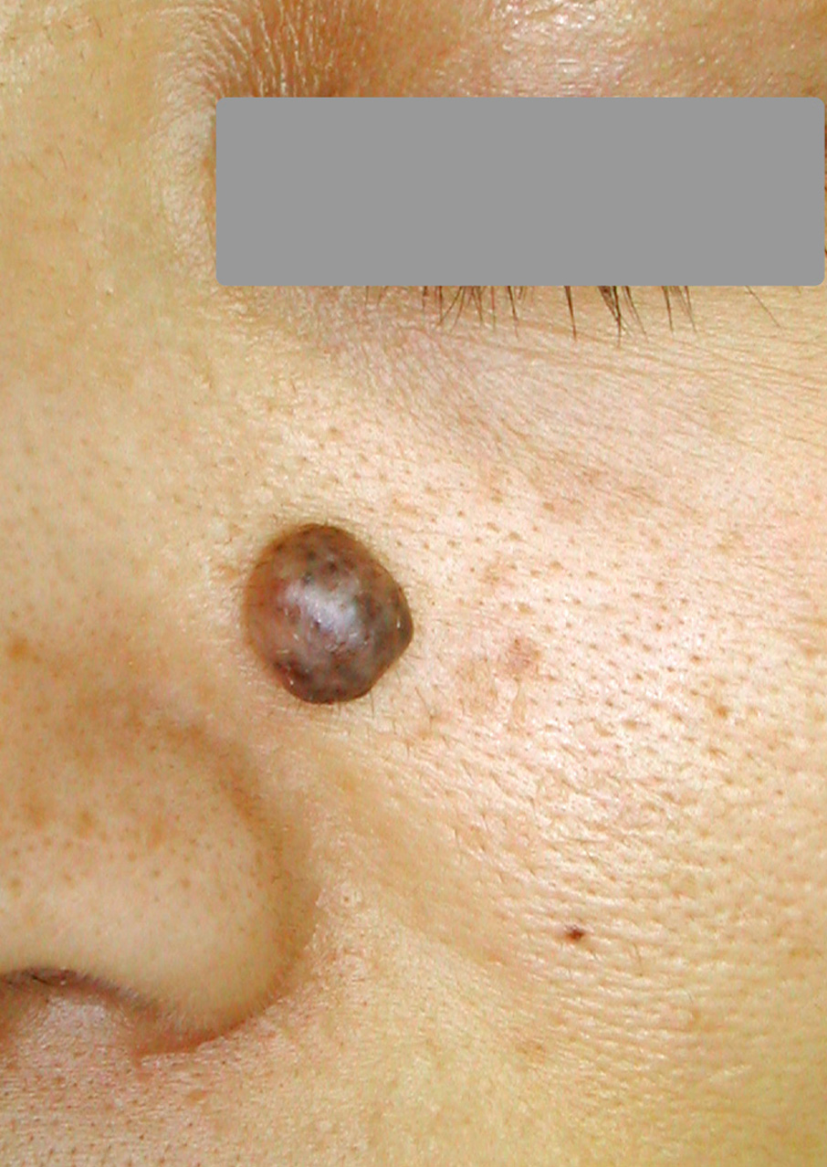 症例１）の治療前