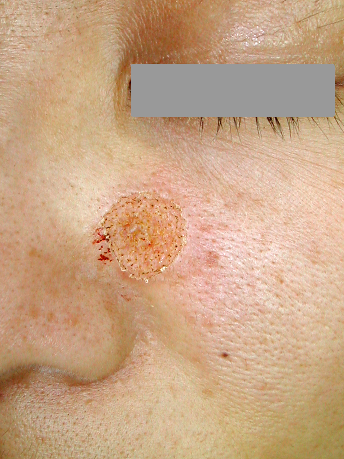 症例１）の治療後