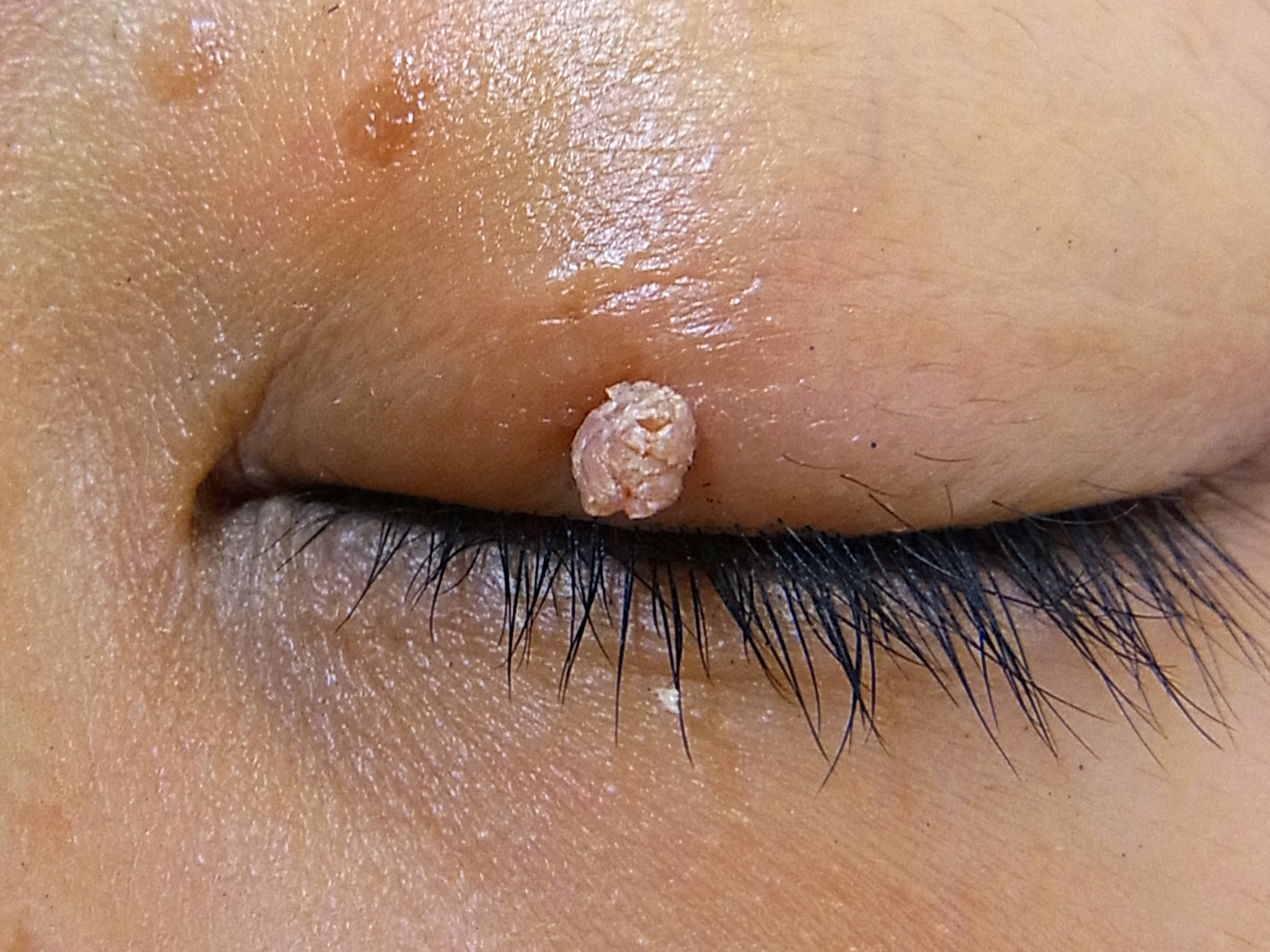 症例３）の治療前