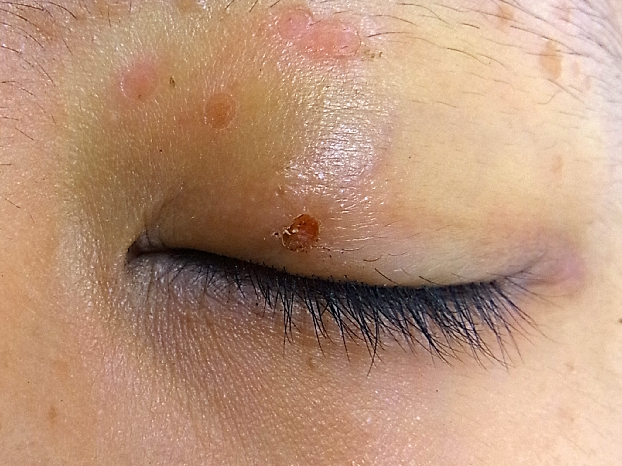 症例３）の治療後