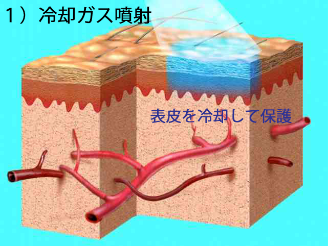 ダイナミッククーリングディバイス(DCD)による冷却のイメージ