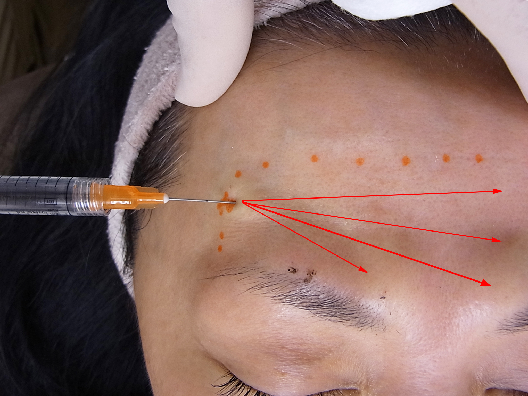 額のヒアルロン酸注入