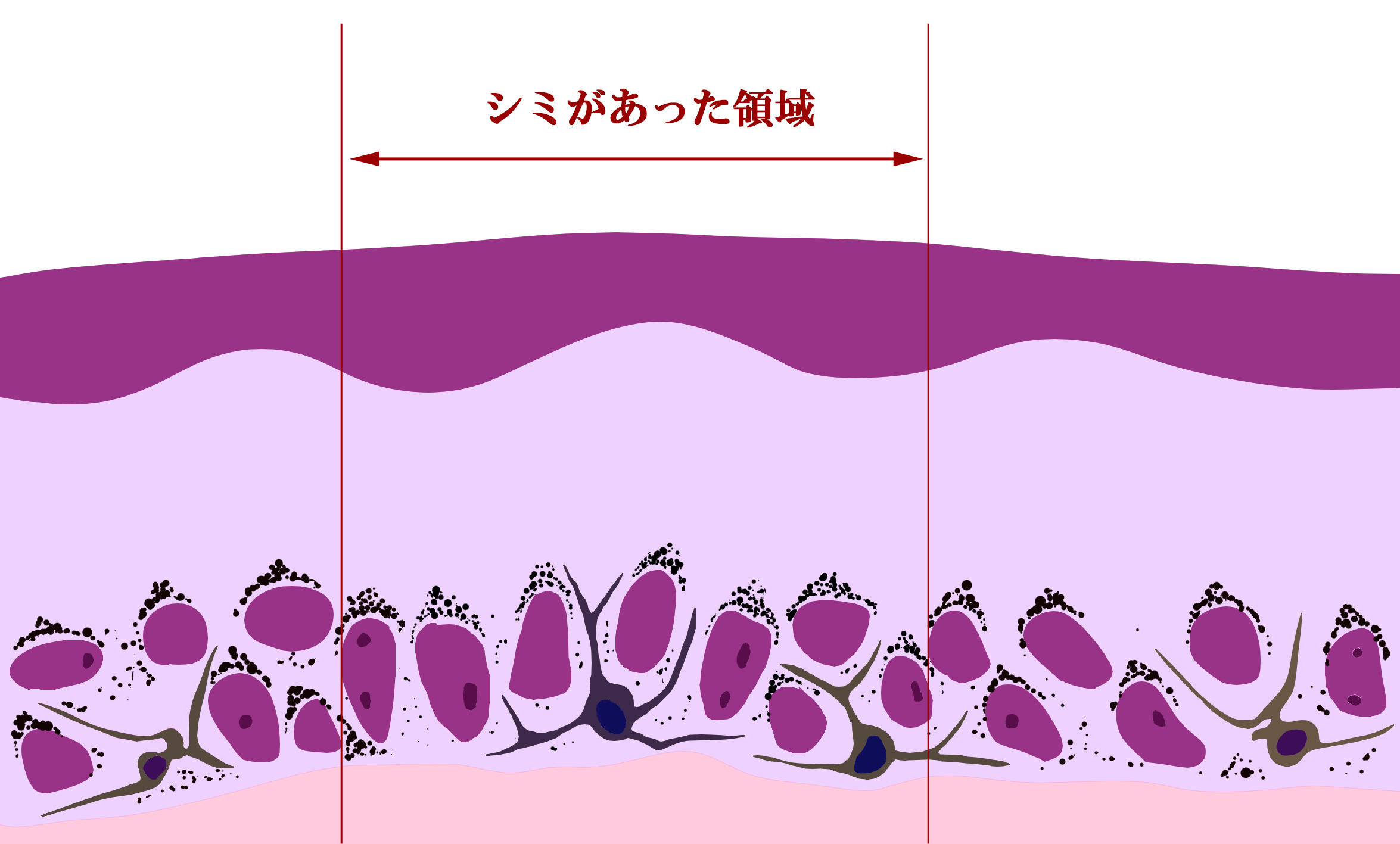 レーザー照射後に皮膚は再生した図
