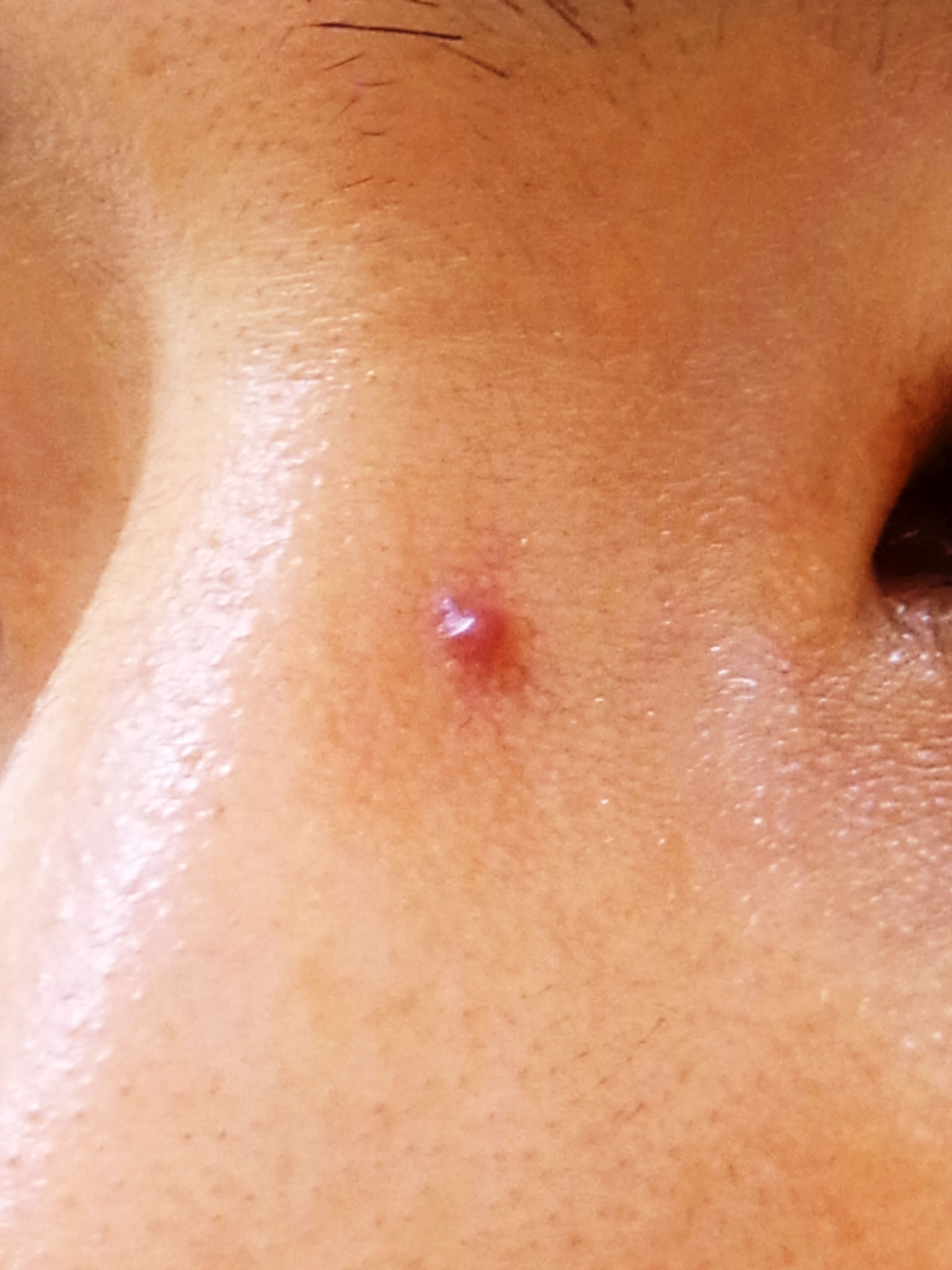 毛細血管拡張症分類の丘疹型