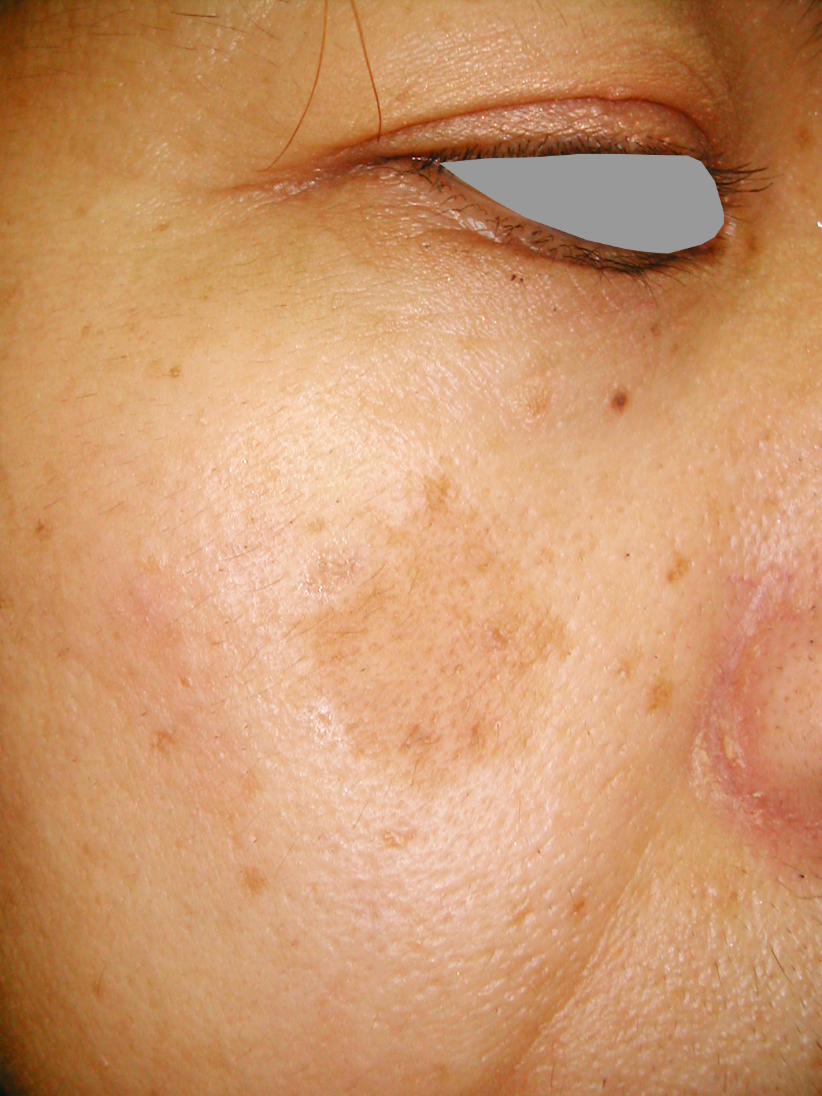 40歳代女性の頬部の老人性色素斑