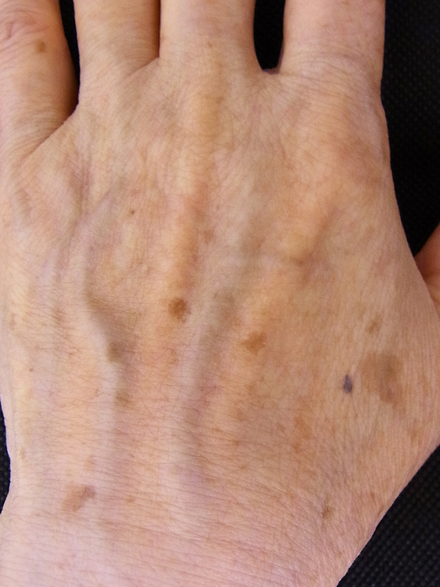 50歳代女性の手背の老人性色素斑