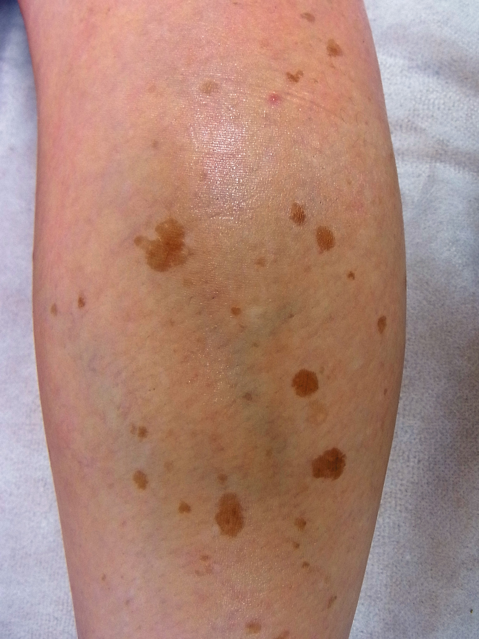 60歳女性の下腿に多発する老人性色素斑