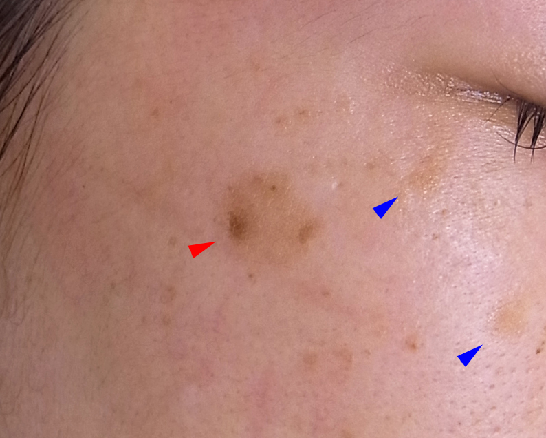 右頬部のシミの費用見積りの例（写真）