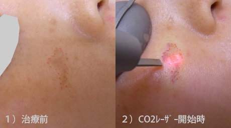 脂漏性角化症の治療ステップ１