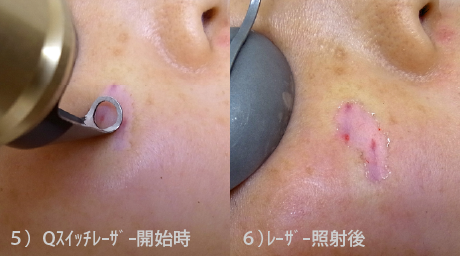 脂漏性角化症の治療ステップ5-6